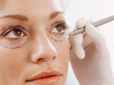 blepharoplastie