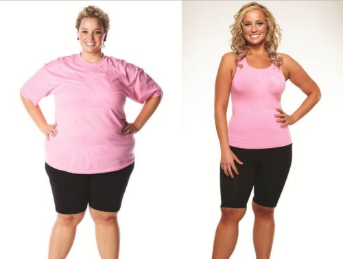 sleeve gastrectomie