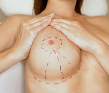 chirurgie de reduction mammaire