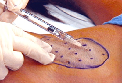 hyperhidrose botox
