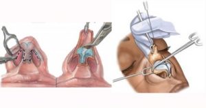 techniques rhinoplastie