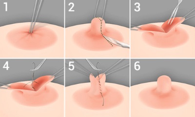 chirurgie mamelon ombilique Belgique