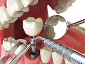 implant dentaire Belgique