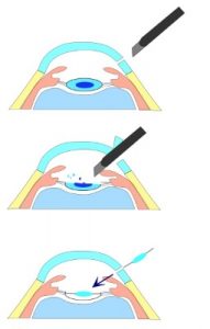 opération lentille intraoculaire Belgique
