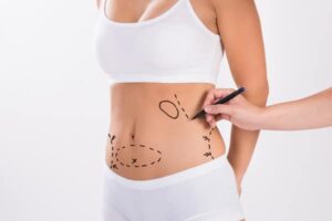 abdominoplastie-pas-cher