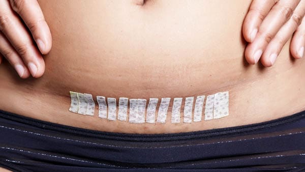 soins apres abdominoplastie