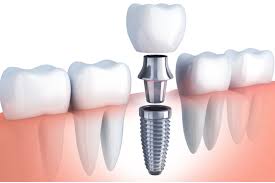 implantologie-dentaire-hongrie