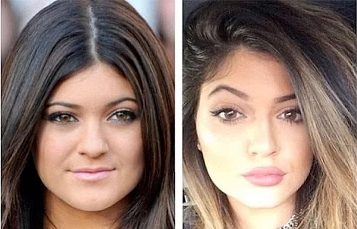 Kylie Jenner et la chirurgie esthétique
