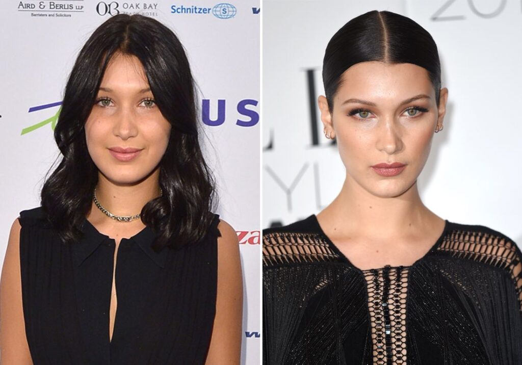 bella hadid chirurgie esthétique