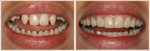 refaire les dents turquie