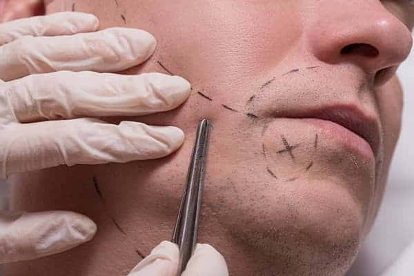prix-implant-barbe-turquie