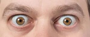 chirurgie-traitement-exophtalmie
